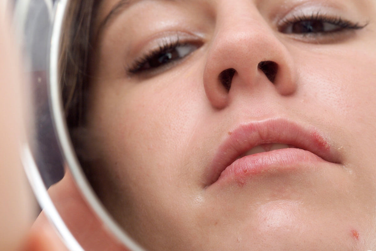 Lippenherpes lässt sich bezwingen